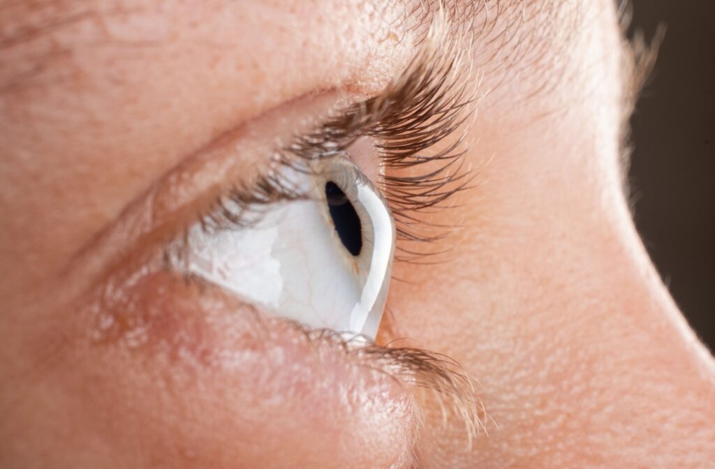 A close-up image of an eye with keratoconus, a prime candidate for scleral lenses.