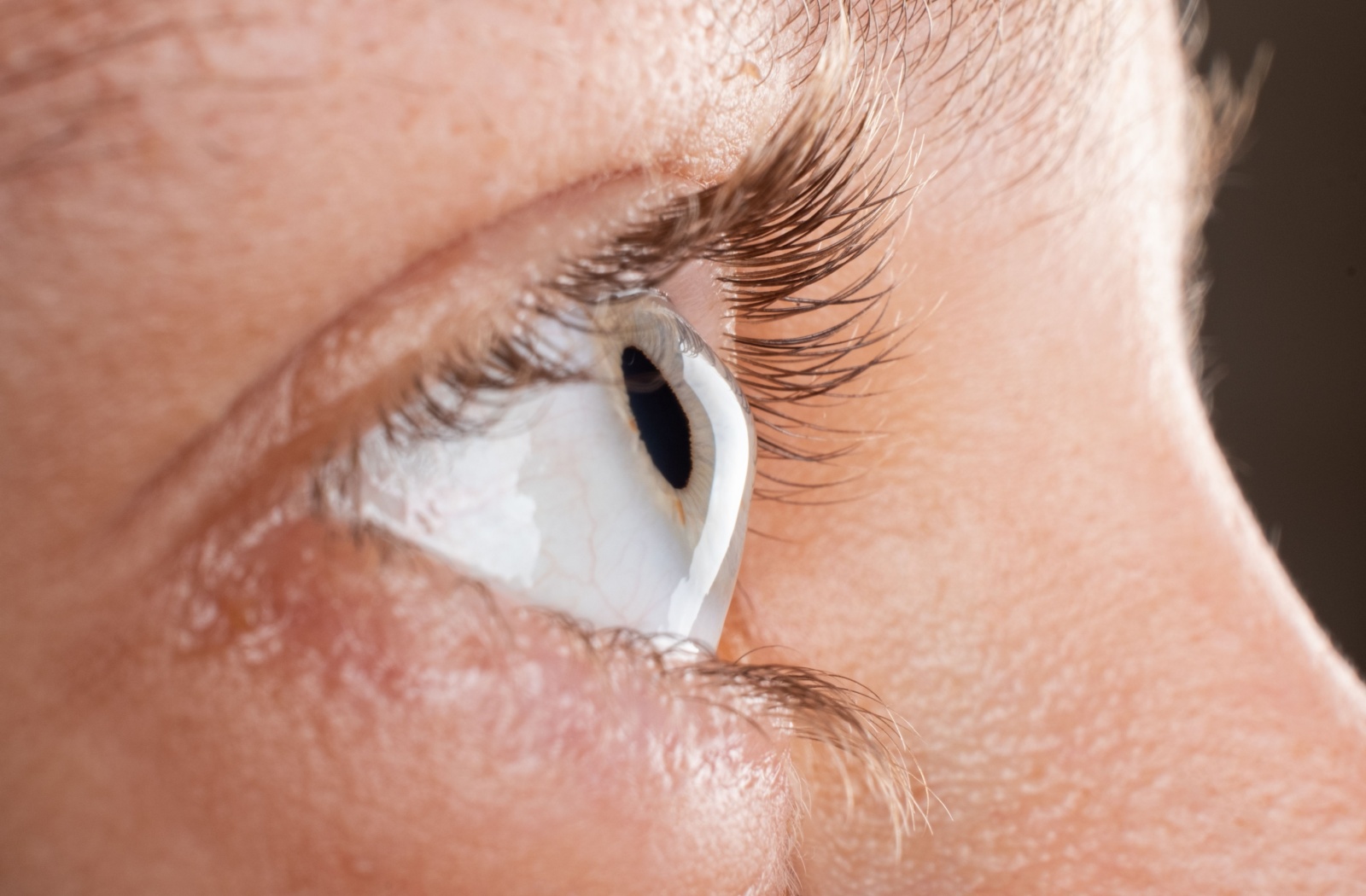 A close-up image of an eye with keratoconus, a prime candidate for scleral lenses.