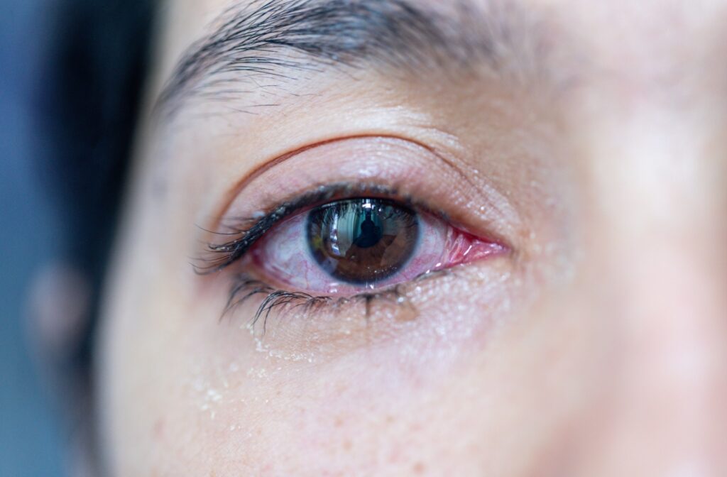 Close up of an individuals eye experiencing dry eye symptoms such as redness and flakiness