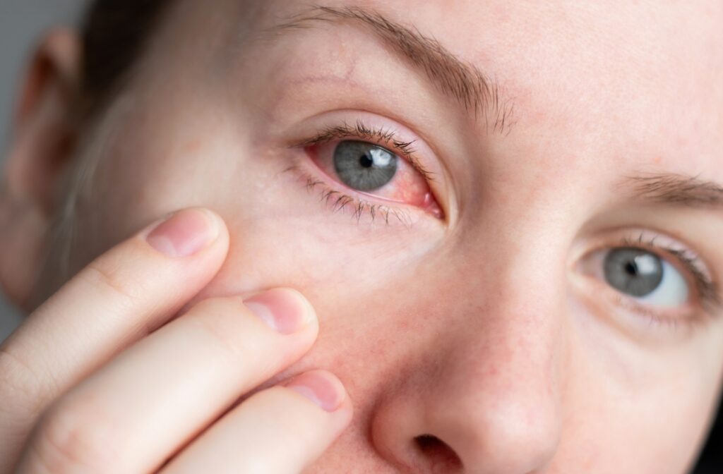 Close up of a person pulling their undereye skin down to showcase their red dry eye